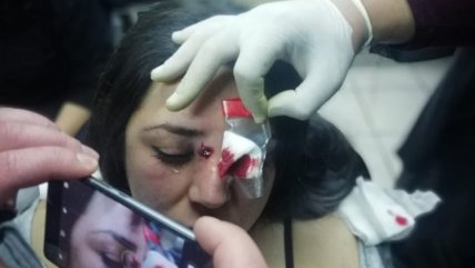   Estudiante que denuncia a Carabineros relató cómo recibió perdigones en manifestación 