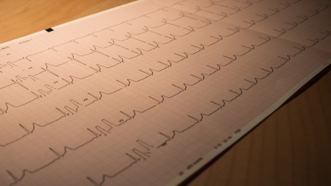   La combinación mortal que dispara el riesgo de infarto 